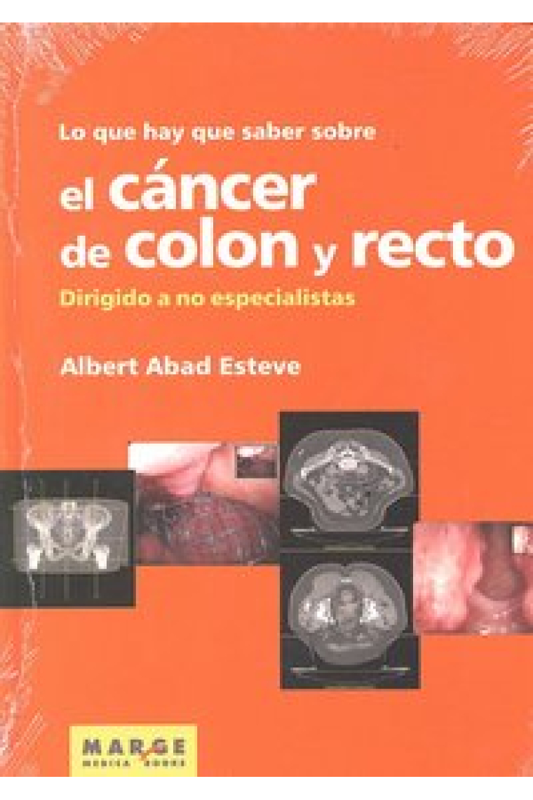 Lo que hay que saber sobre el cáncer de colon y recto