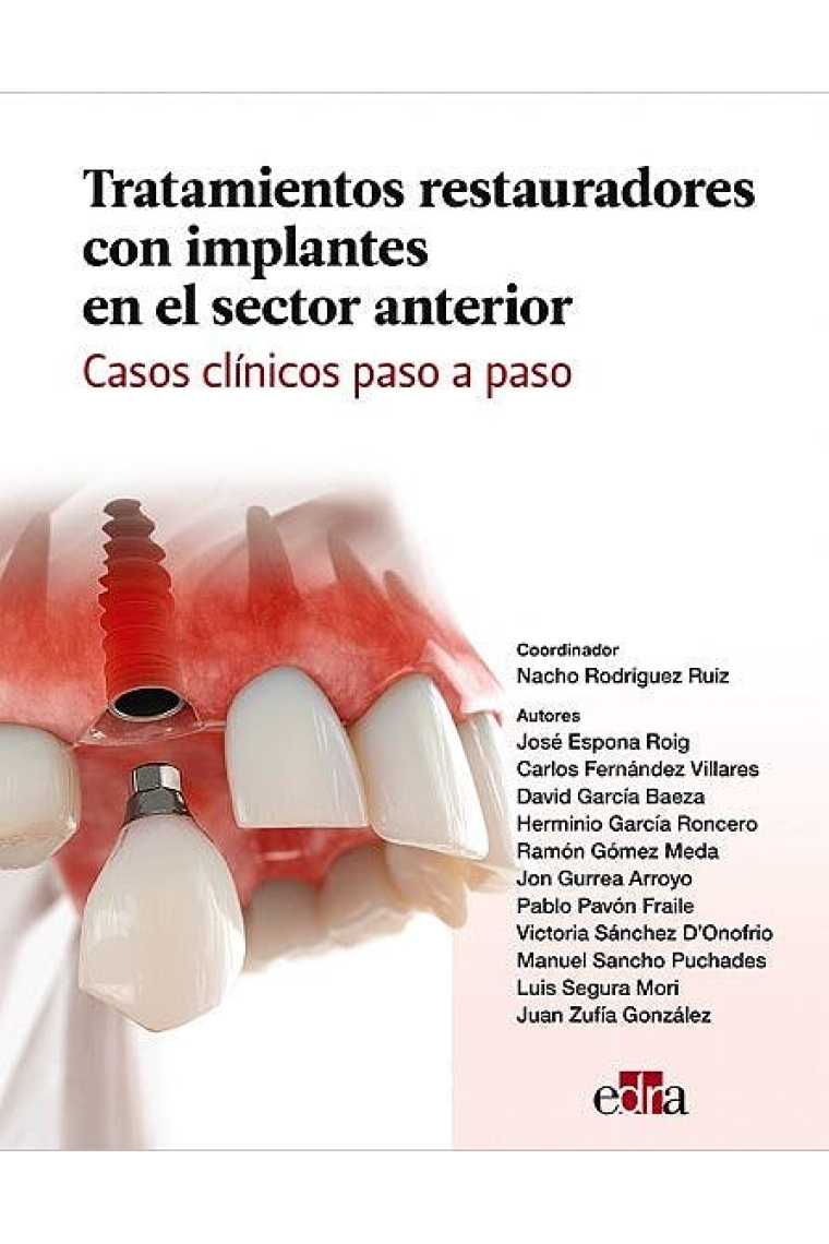 TRATAMIENTOS RESTAURADORES CON IMPLANTES EN EL SECTOR ANTERI